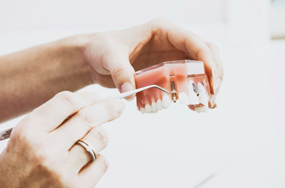 Exploring the Lifespan of Dental Implants: What You Need to Know
